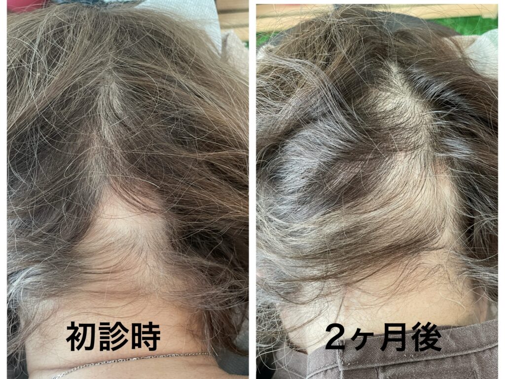 円形脱毛