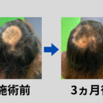 円形性脱毛症の鍼灸治療