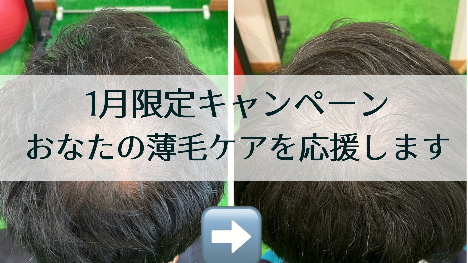 薄毛1月キャンペーン