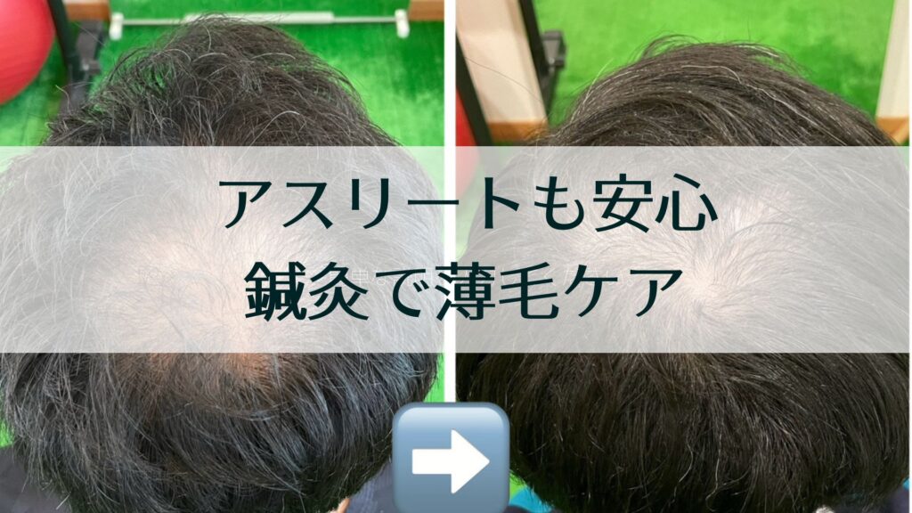 アスリートも安心鍼灸で薄毛ケア